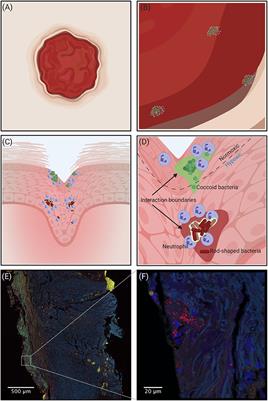 Do Mixed-Species Biofilms Dominate in Chronic Infections?–Need for in situ Visualization of Bacterial Organization